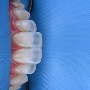 Modelos dentales impresos en 3D del curso PRINT 3D en odontología