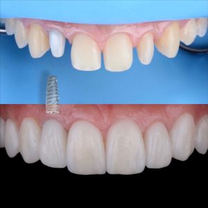 Curso online de implantología dental pregrabado de Ricardo Omi Estudio