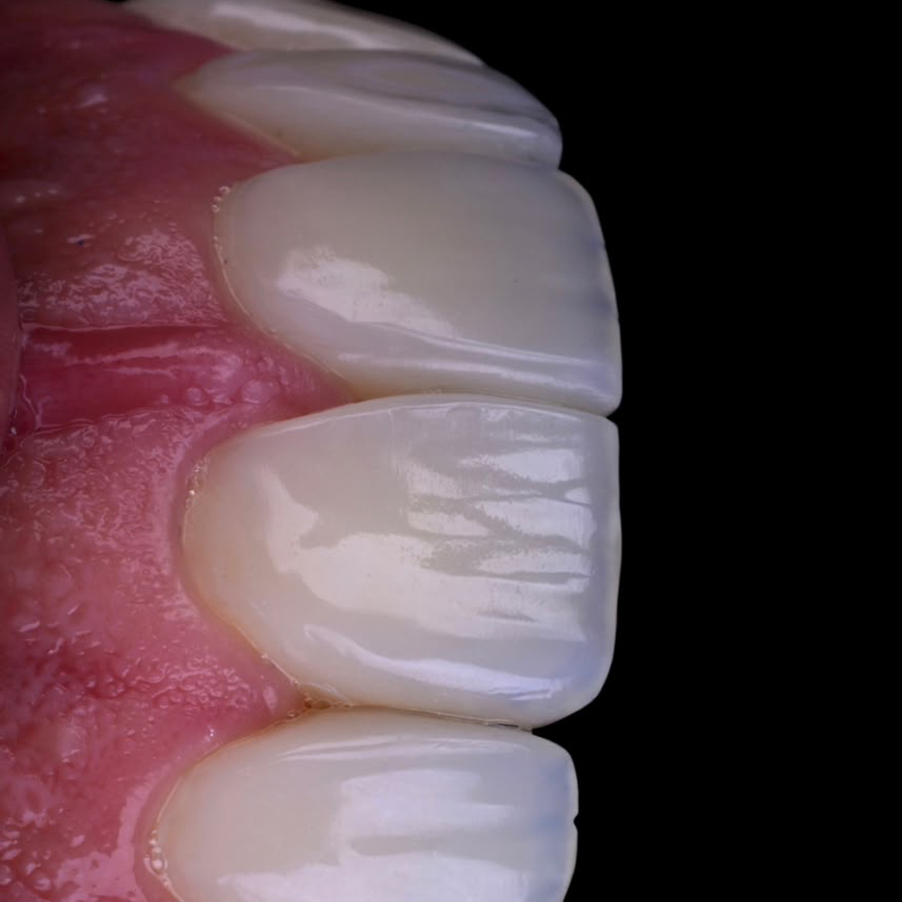 Close-up clínico de un procedimiento de odontología estética del curso pregrabado de Ricardo Omi